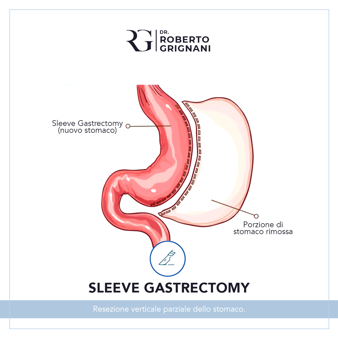 sleeve gastrectomy intervento chirurgico per il trattamento dell'obesità